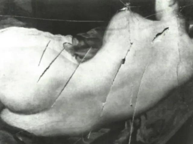 Proctalgia Fugax